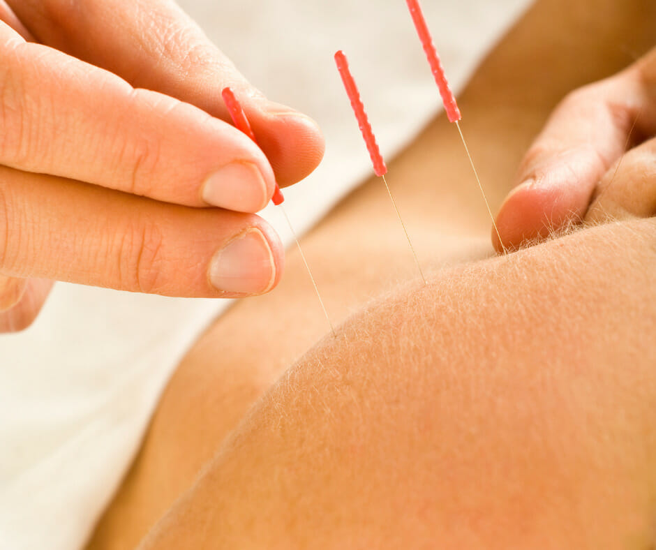 Role of Acupuncture Treatment 