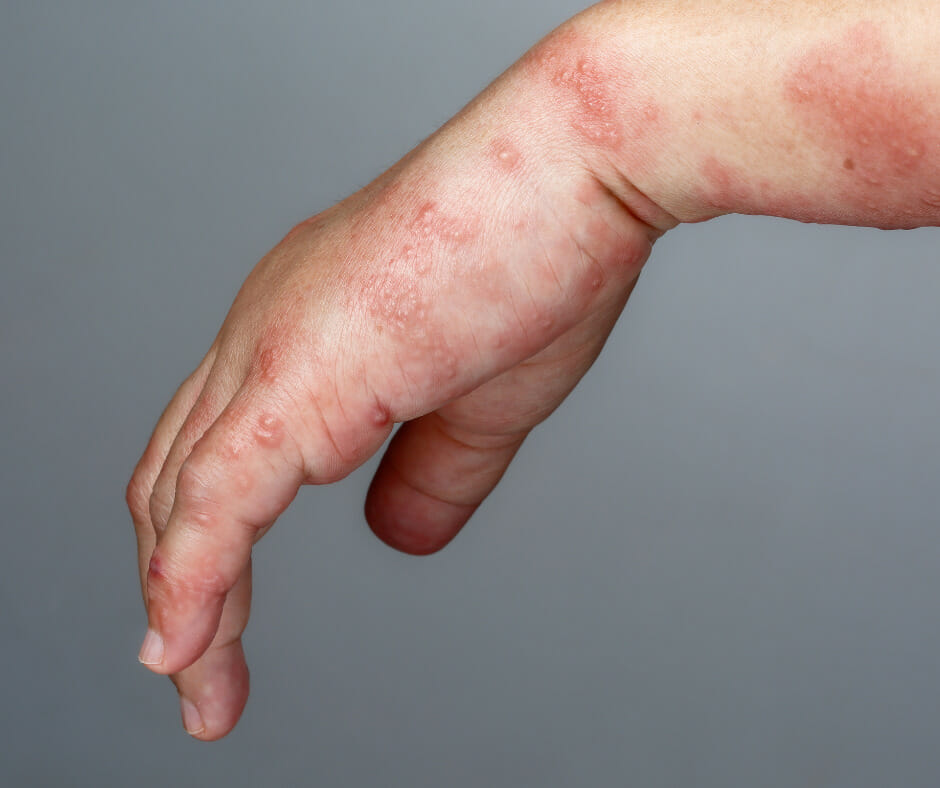 A close-up image of a person's arm with red, itchy patches, which may be a symptom of alcohol withdrawal itching in Alcoholic Neuropathy.