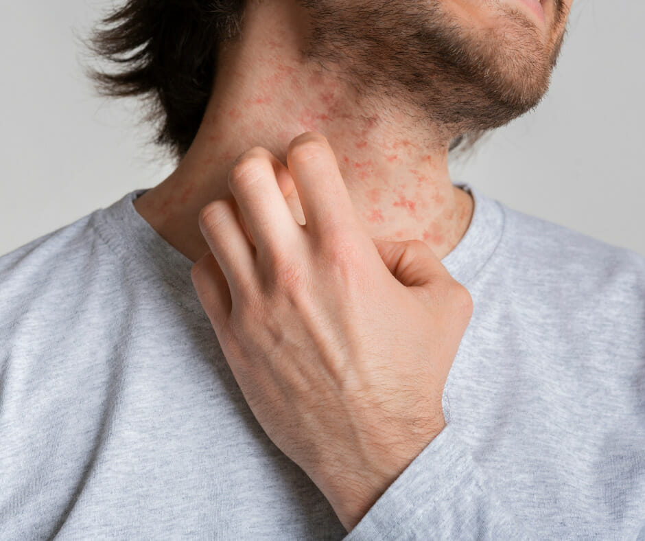 A person using topical remedies to relieve skin itching caused by alcohol withdrawal